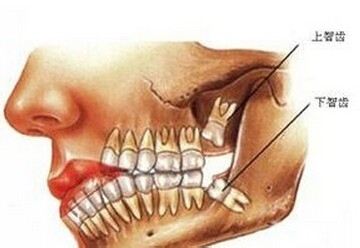 为什么会长智齿？人类进化的残余物